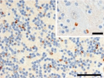 Image: C9RANT Neuropathologgy: Immunohistochemistry of postmortem tissue reveals neuronal inclusions of C9RANT in the brains of patients with c9FTD/ALS (Photo courtesy of Neuron, Ash et al).